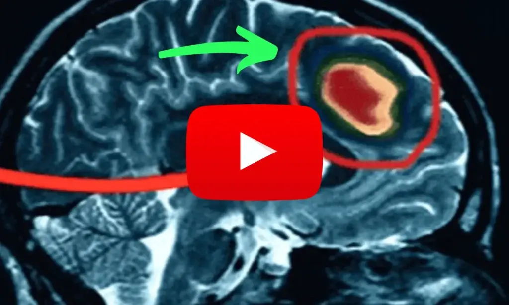 brain scan showing tinnitus damage